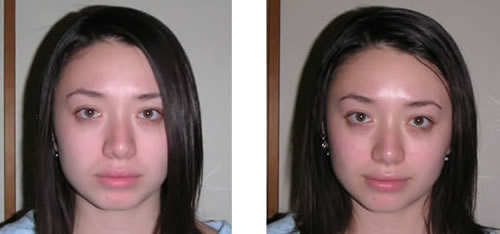 Before and after Belavi Facelift Massage